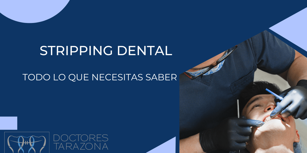 El stripping dental en ortodoncia: Todo lo que necesitas saber.