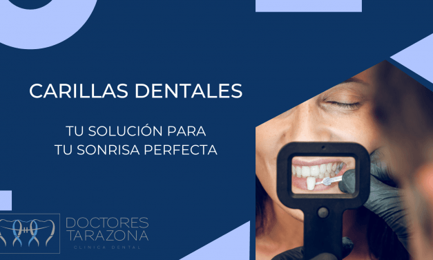 Carillas dentales: tu solución estética para tu sonrisa perfecta