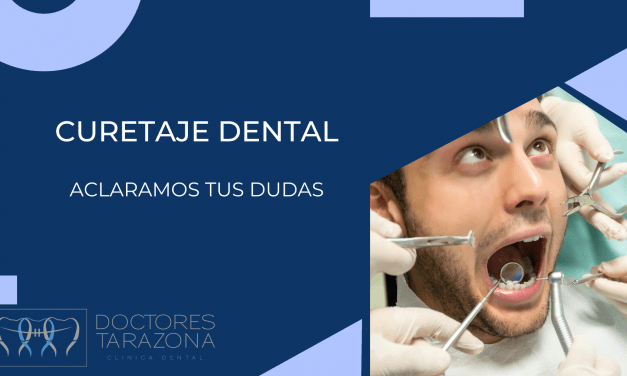 Curetaje Dental: ¿Conoces este tratamiento de periodoncia?