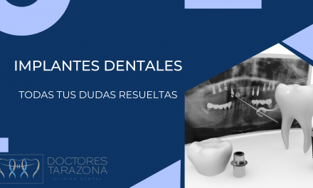 Implantes dentales: Todas tus dudas resueltas.