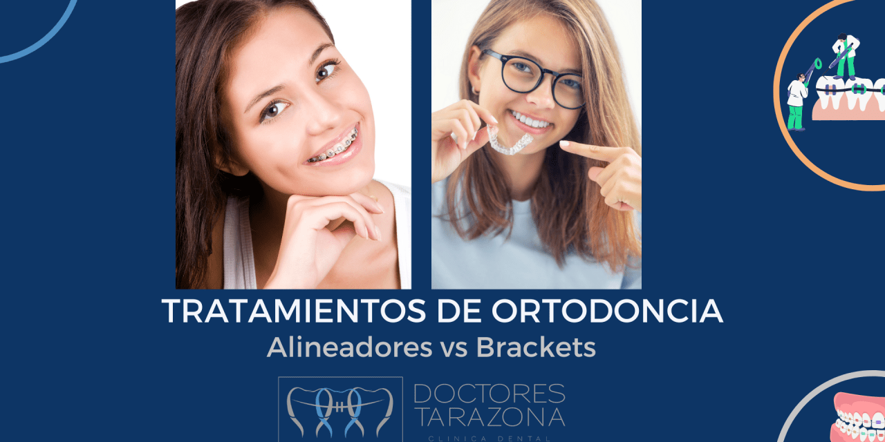 Tratamiento de ortodoncia en Valencia: Alineadores o brackets