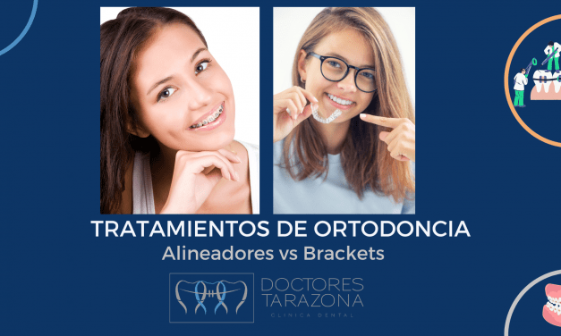 Tratamiento de ortodoncia en Valencia: Alineadores o brackets
