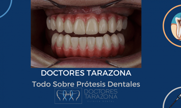 Todo Sobre Prótesis Dentales – Sonrisas Perfectas