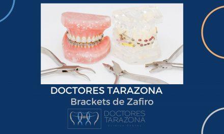 Brackets de zafiro: La mejor opción en brackets para tu sonrisa