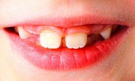 Qué es la agenesia dental: causas, síntomas y soluciones