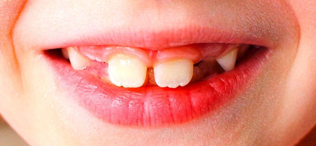 Qué es la agenesia dental: causas, síntomas y soluciones