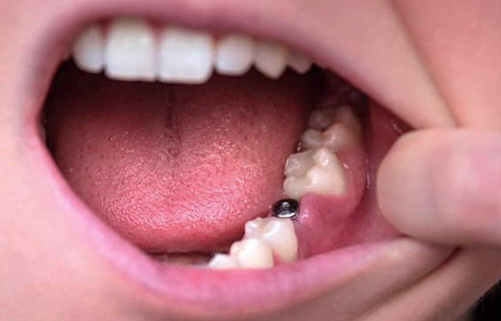 Cómo saber si hay infección en un implante dental