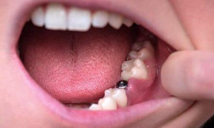 Cómo saber si hay infección en un implante dental