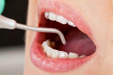 ¿Cómo eliminar el sarro duro detrás de los dientes de forma efectiva?