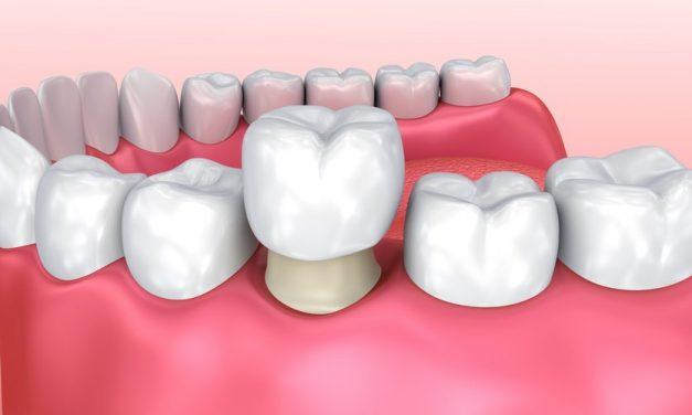 ¿Se puede quitar una corona dental y volver a poner? Todo lo que debes saber