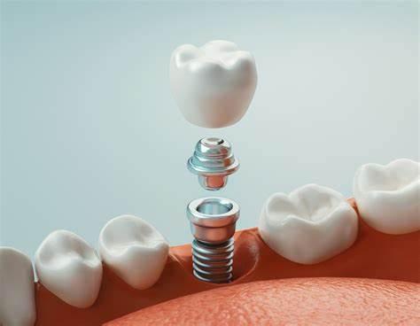 Partes de un implante dental: conoce su estructura y función