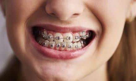 ¿Se puede comer chicle con brackets? Descubre lo que debes saber