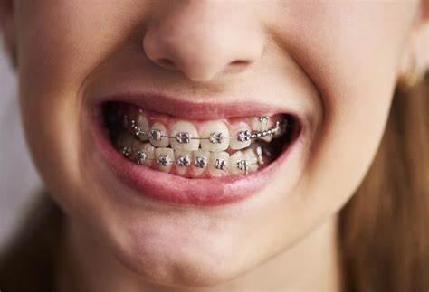 ¿Se puede comer chicle con brackets? Descubre lo que debes saber