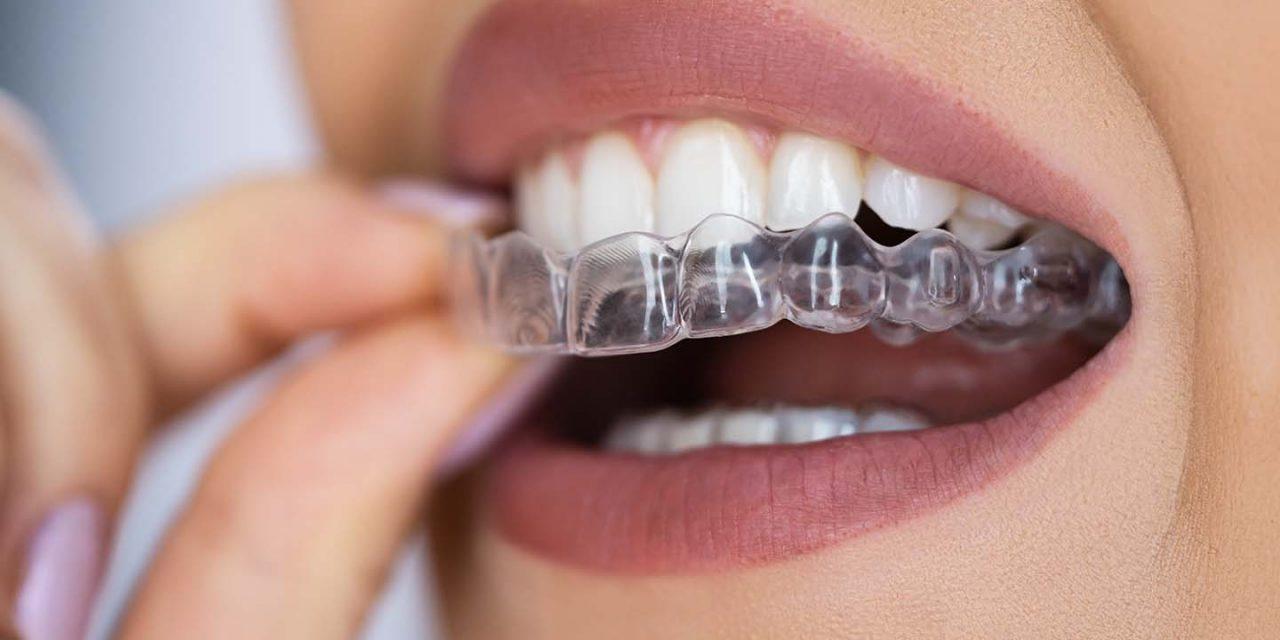 ¿Cuánto tarda la ortodoncia invisible en hacer efecto? Descubre el tiempo real de tratamiento y resultados