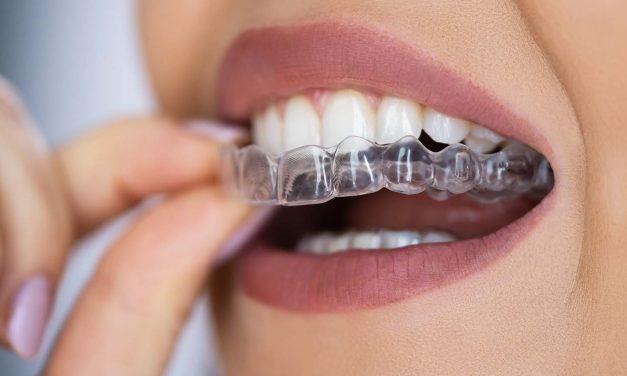 ¿Cuánto tarda la ortodoncia invisible en hacer efecto? Descubre el tiempo real de tratamiento y resultados