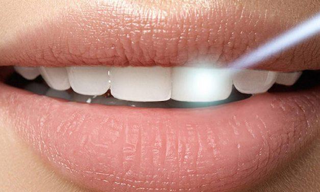 ¿Cuándo se empiezan a notar los resultados del blanqueamiento dental? Descubre lo que nadie te cuenta
