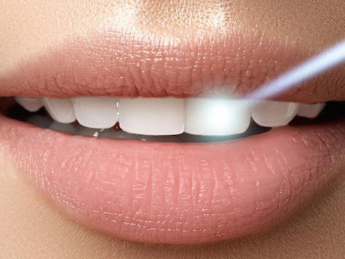¿Cuándo se empiezan a notar los resultados del blanqueamiento dental? Descubre lo que nadie te cuenta